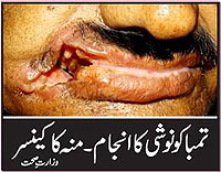 Pakistan 2010 Health Effects mouth - diseased organ, gross
